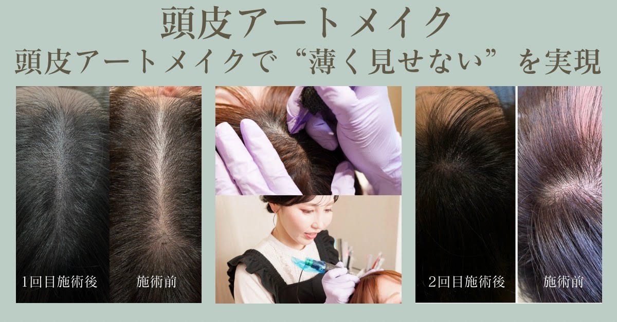 頭皮アートメイク
