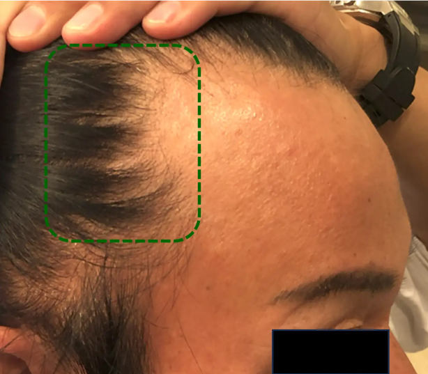 薄毛治療後
