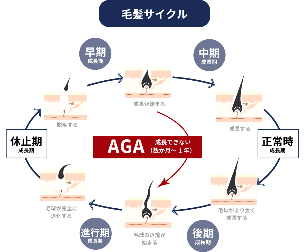 AGA治療について